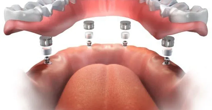 Happy patient pointing to smile