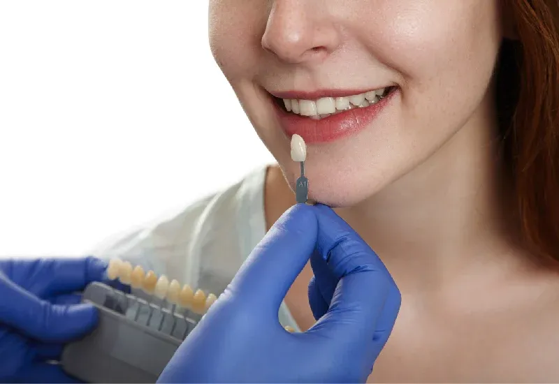 Teeth whitening vs Porcelain Veneers: Key Differences