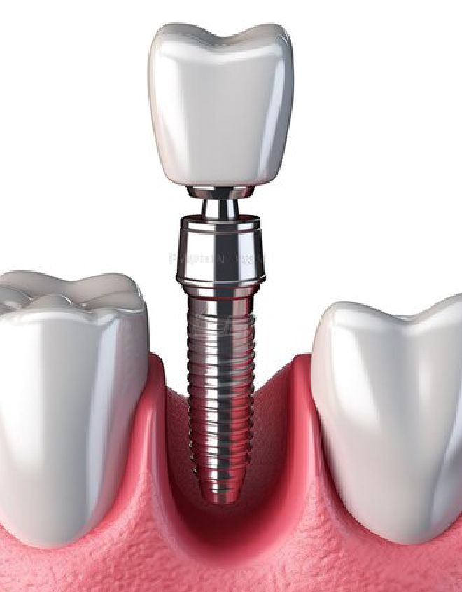 Single Tooth Dental-Implant